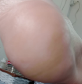 Después del tratamiento de Talones agrietados